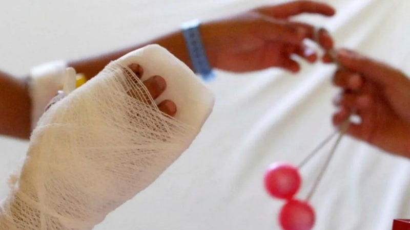 CEHNIQ niños quemados CEHNIQ niños quemados