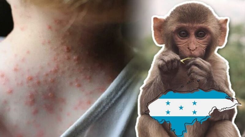 Viruela del mono en Honduras Viruela del mono en Honduras