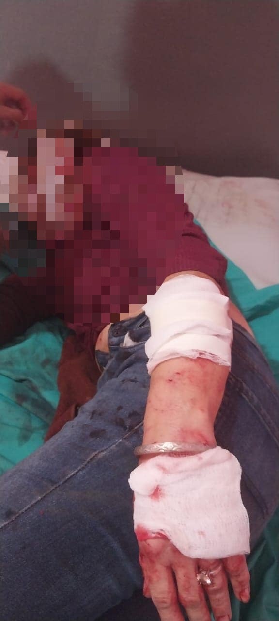 Mujer resulta gravemente herida tras ataque de sus propios pitbulls