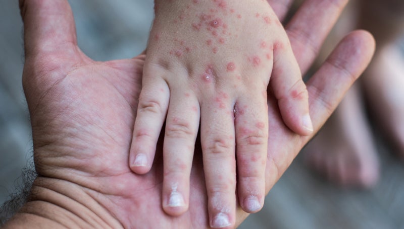 Diferencias entre sarampión varicela