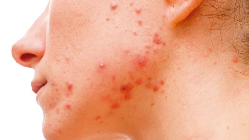 Acné en mujeres adultas: una afección dermatológica con profundo impacto emocional