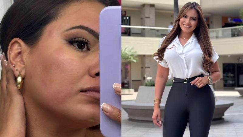 Alejandra Rubio ¿Qué le pasó en la cara? Alejandra Rubio publica fotos que inquietan a sus seguidores