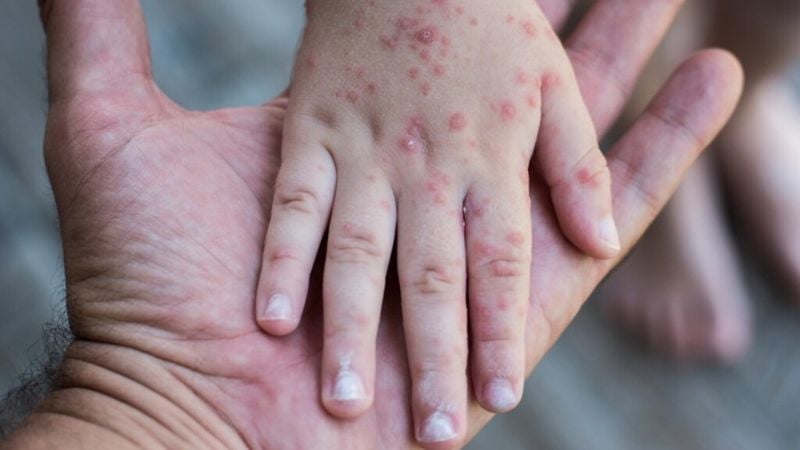 Honduras en alerta máxima por sarampión