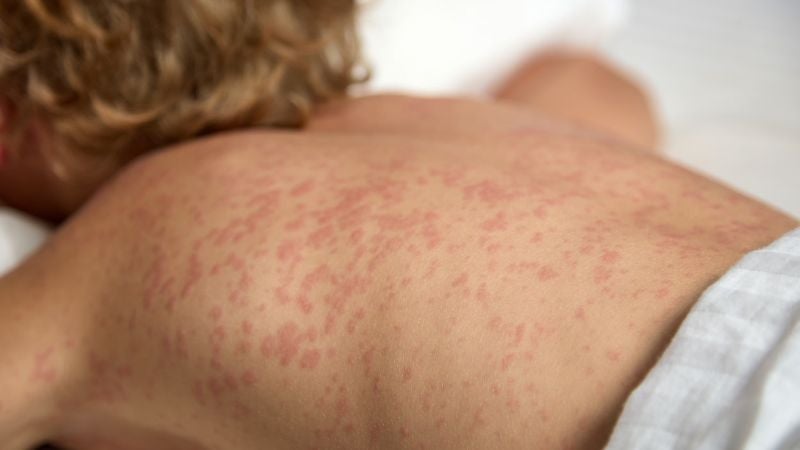 Carnet vacunación sarampión viajeros Carnet vacunación sarampión viajeros