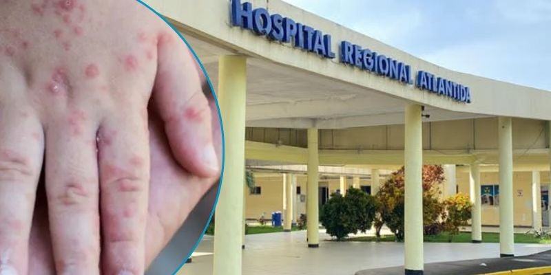 Atlántida reporta seis casos sospechosos de sarampión