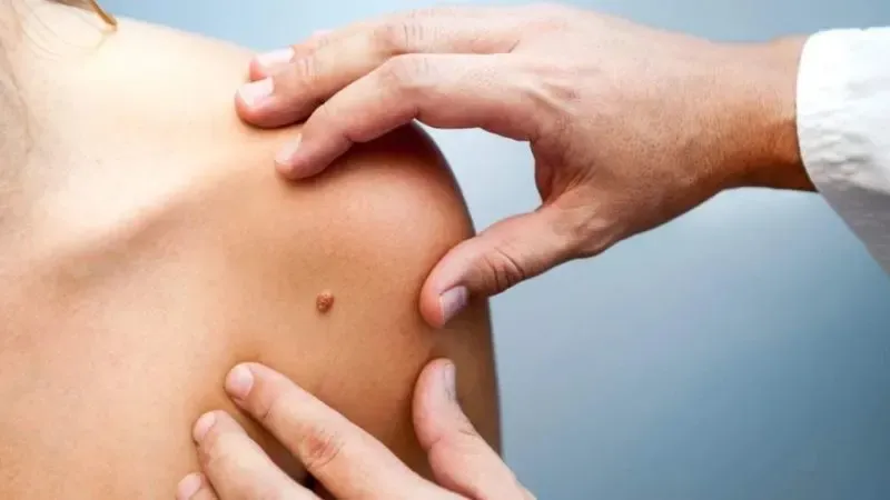 El cáncer de piel aumenta en jóvenes: especialistas alertan
