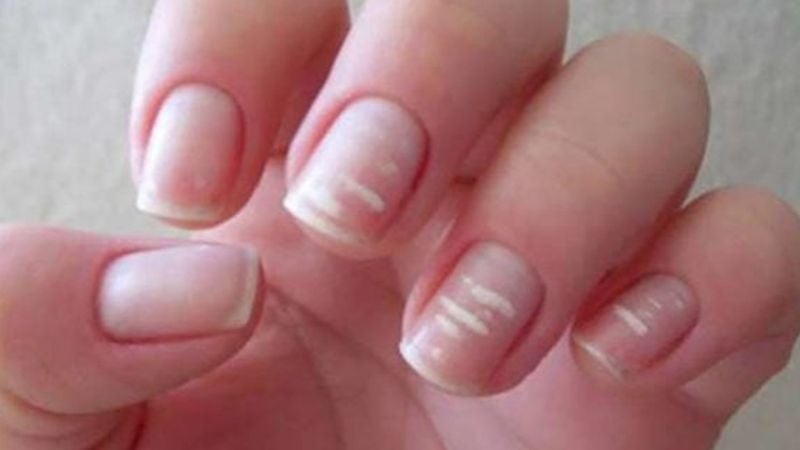 Manchas blancas en las uñas: qué indican y cuándo deben preocupar
