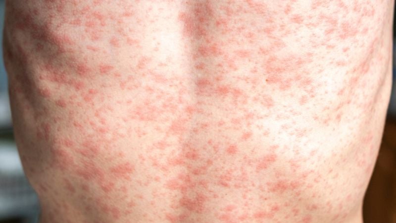 sarampión Honduras Honduras descarta 22 casos sospechosos de sarampión