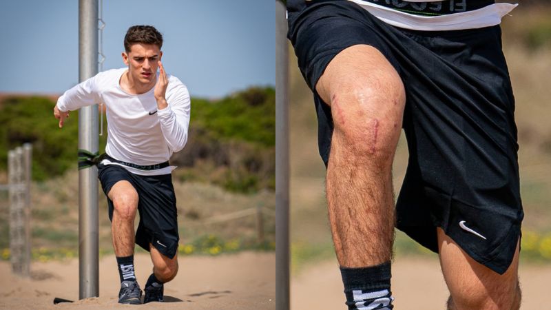 El mediocampista culé quedó con algunas marcas en su rodilla luego de su operación de ligamento cruzado.