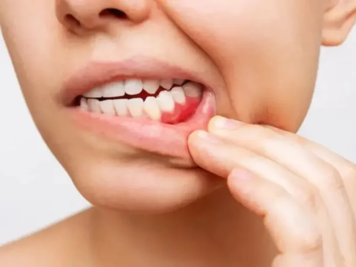 Gingivitis: la amenaza silenciosa que pone en riesgo la salud bucodental