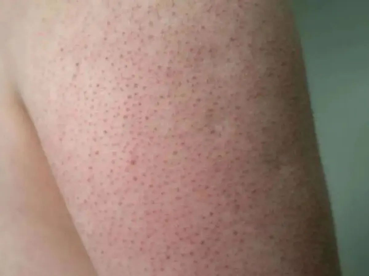 Qué es la "piel de fresa"