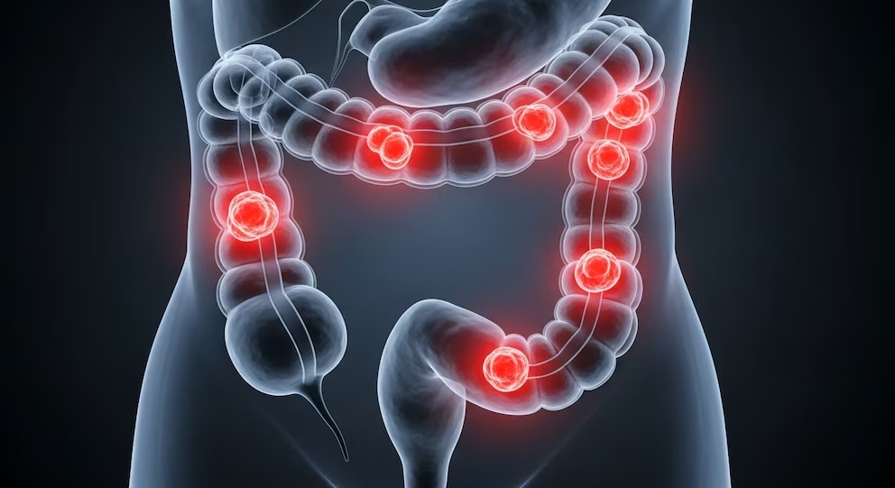 Proctitis: qué es y de qué manera puede afectar la vida diaria