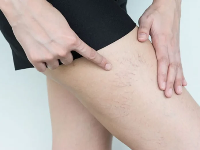 Arañas vasculares en las piernas