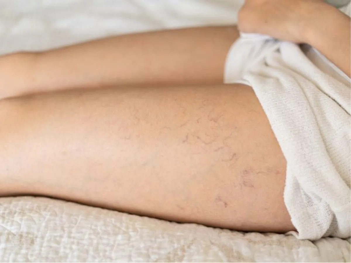 Arañas vasculares en las piernas