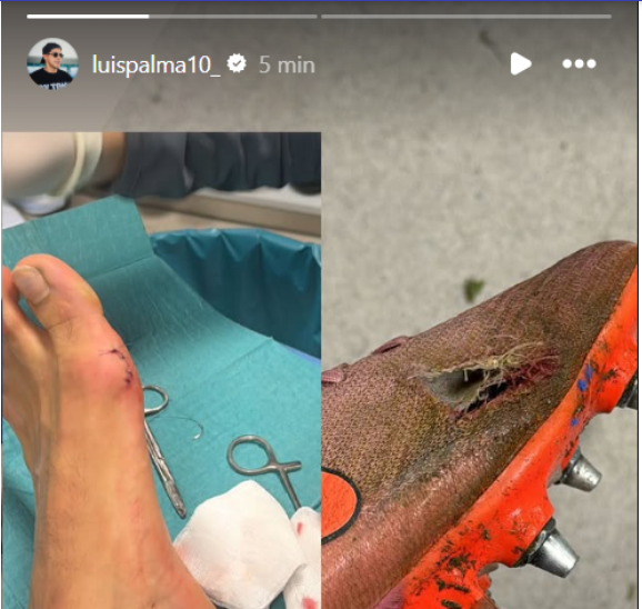 En sus redes sociales, Luis Palma muestra como quedó su pie y el taco después del pisotón que recibió durante el partido contra el Sigma Olomouc.