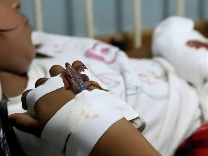 Más de 450 menores han sido atendidos por quemaduras en lo que va de 2025