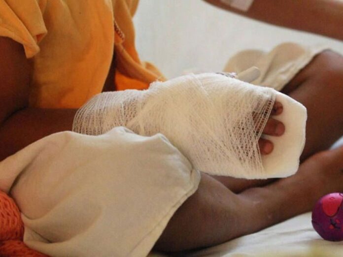 Niños quemados pólvora Navidad