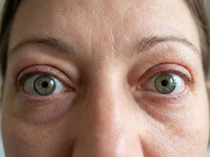 Cómo detectar a tiempo la enfermedad que hincha los ojos