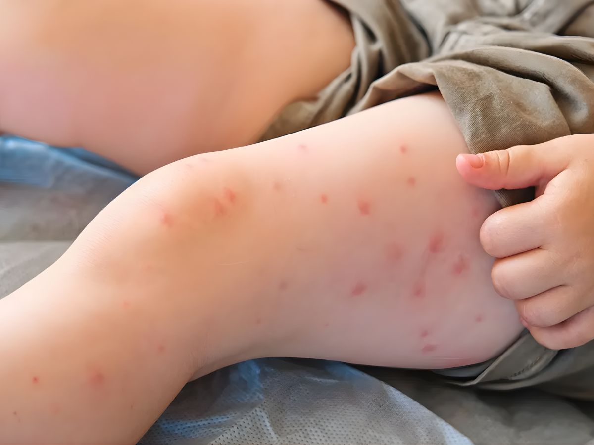 sintomas-del-sarampion